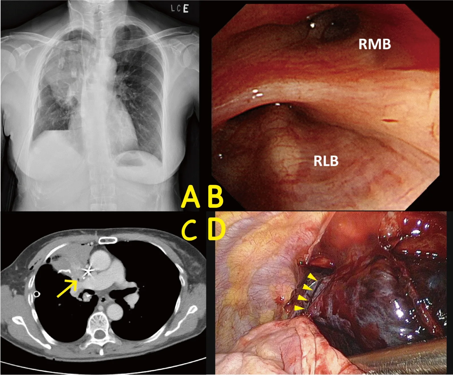 A patient, who was diagnosed with Lung Adenocarcinoma