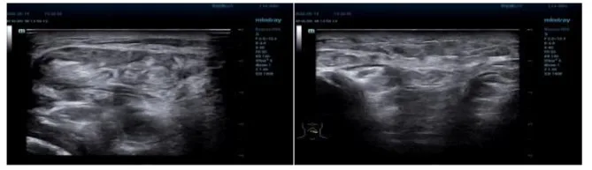 A patient, who was diagnosed with Stage IV Lung Adenocarcinoma