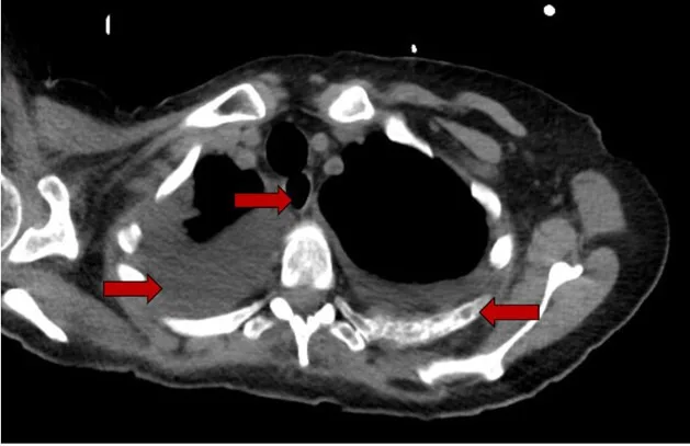 A patient, who was diagnosed with Stage IV Invasive Ductal Carcinoma
