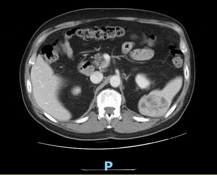 A patient, who was diagnosed with Stage I Lung Adenocarcinoma