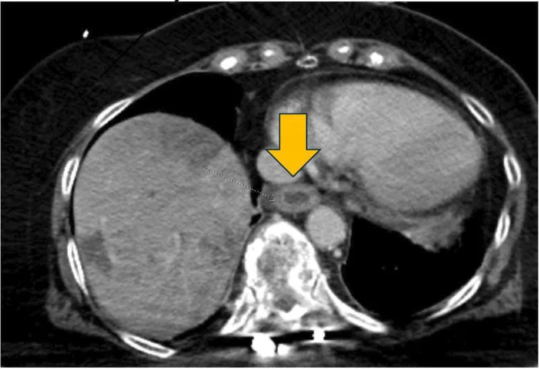 A patient, who was diagnosed with Stage IV Lung Adenocarcinoma