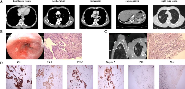 A patient, who was diagnosed with Lung Adenocarcinoma