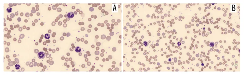 A patient, who was diagnosed with Stage IV Lung Adenocarcinoma