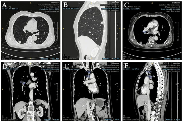 A patient, who was diagnosed with Stage I Small Cell Lung Cancer