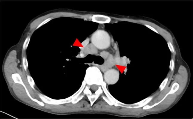 A patient, who was diagnosed with Lung Adenocarcinoma