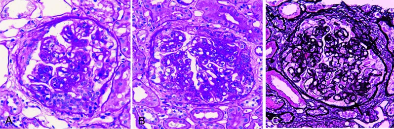 A patient, who was diagnosed with Invasive Ductal Carcinoma