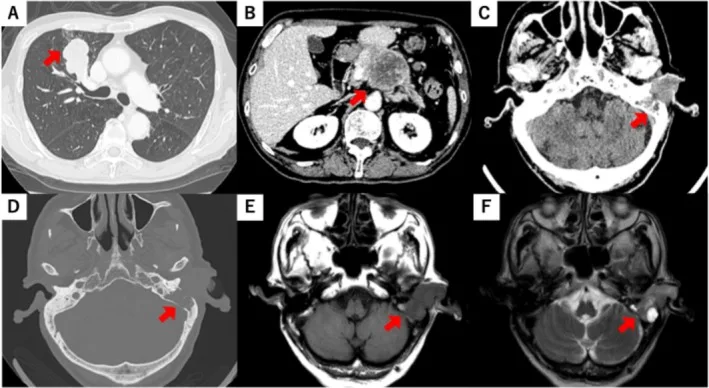 A patient, who was diagnosed with Stage IV Small Cell Lung Cancer