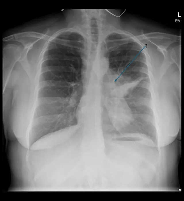 A patient, who was diagnosed with Stage IV Small Cell Lung Cancer