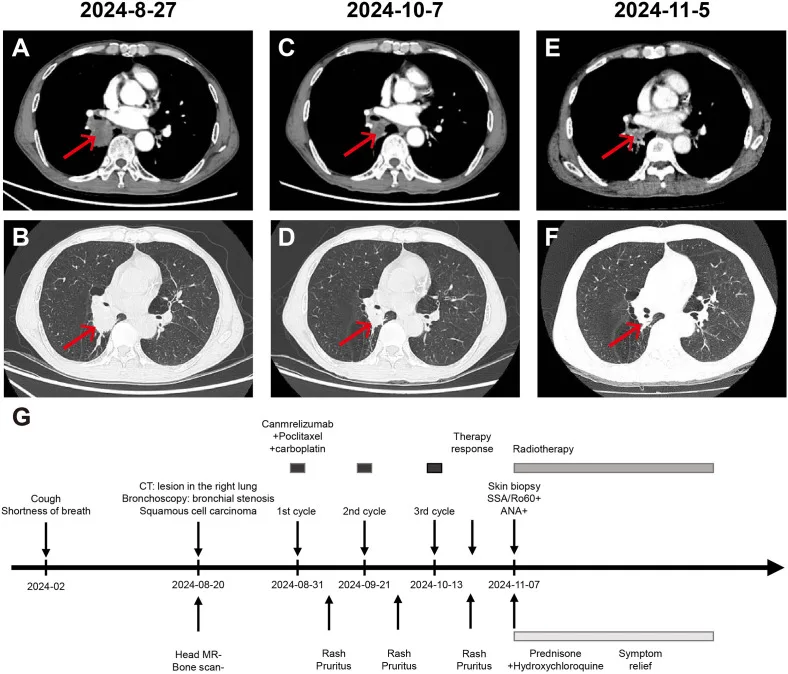 A patient, who was diagnosed with Stage II Lung Squamous Cell Carcinoma