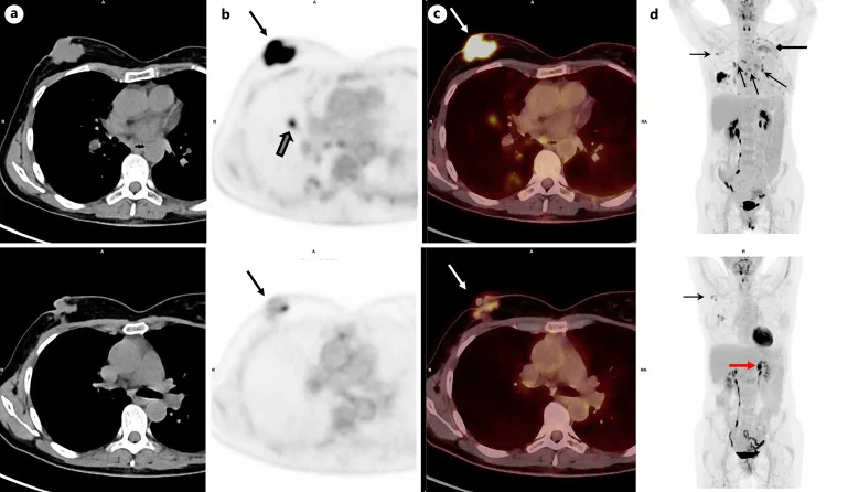 A patient, who was diagnosed with Stage IV Invasive Ductal Carcinoma