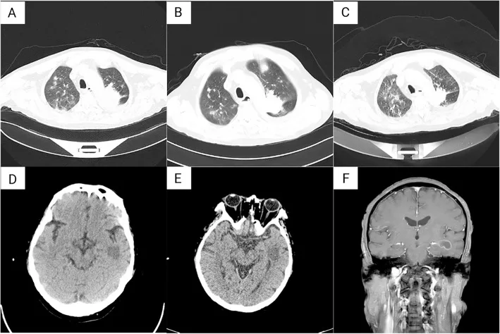 A patient, who was diagnosed with Lung Squamous Cell Carcinoma