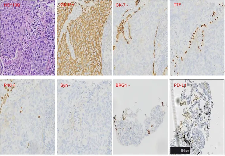 A patient, who was diagnosed with Stage IV Non-Small Cell Lung Cancer
