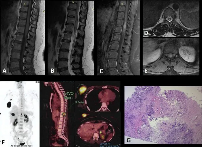 A patient, who was diagnosed with Stage IV Breast Cancer