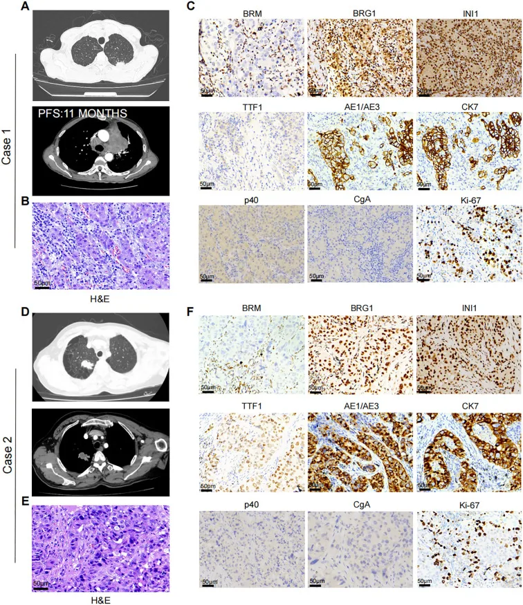 A patient, who was diagnosed with Lung Adenocarcinoma