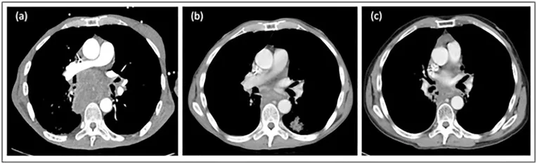 A patient, who was diagnosed with Stage III Lung Adenocarcinoma