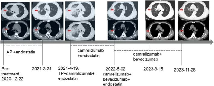 A patient, who was diagnosed with Stage IV Lung Adenocarcinoma