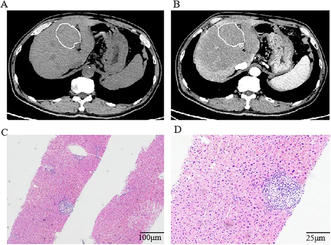 A patient, who was diagnosed with Lung Squamous Cell Carcinoma