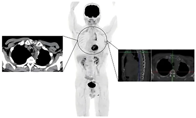 A patient, who was diagnosed with Stage IV Lung Cancer
