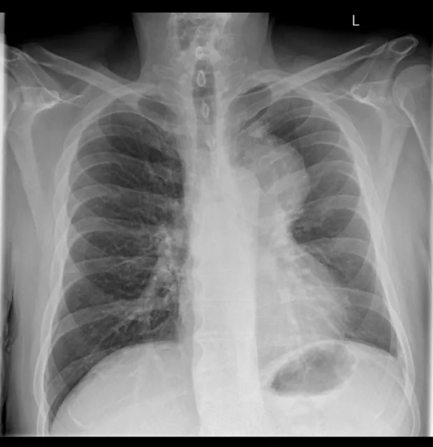 A patient, who was diagnosed with Lung Squamous Cell Carcinoma