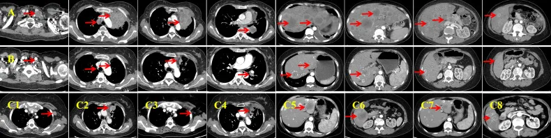 A patient, who was diagnosed with Stage IV Non-Small Cell Lung Cancer