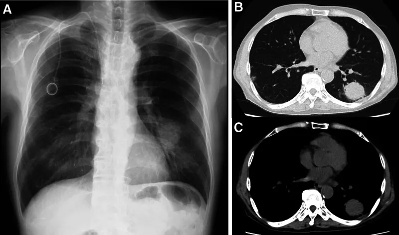A patient, who was diagnosed with Stage IV Lung Adenocarcinoma