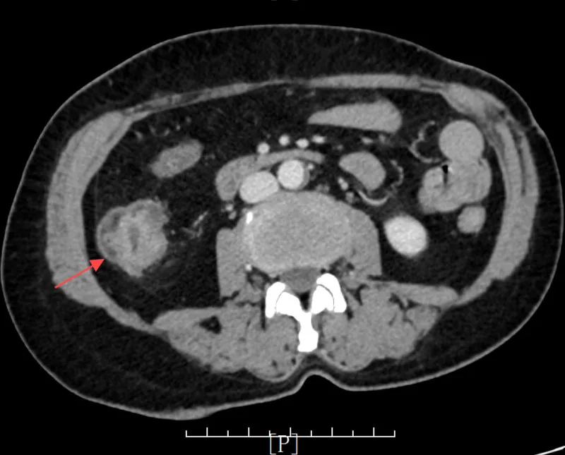 A patient, who was diagnosed with Stage III Colorectal Adenocarcinoma