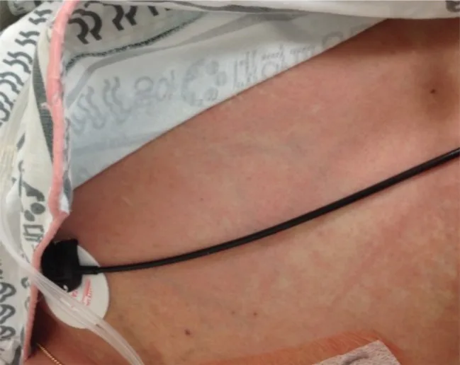A patient, who was diagnosed with Stage IV Colorectal Cancer