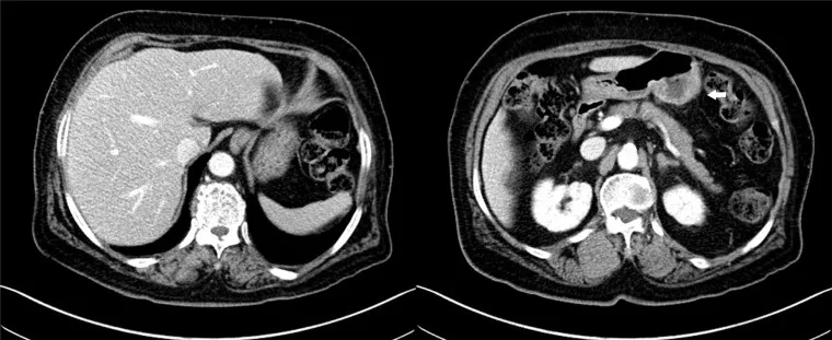 A patient, who was diagnosed with Stage IV Gastric Adenocarcinoma