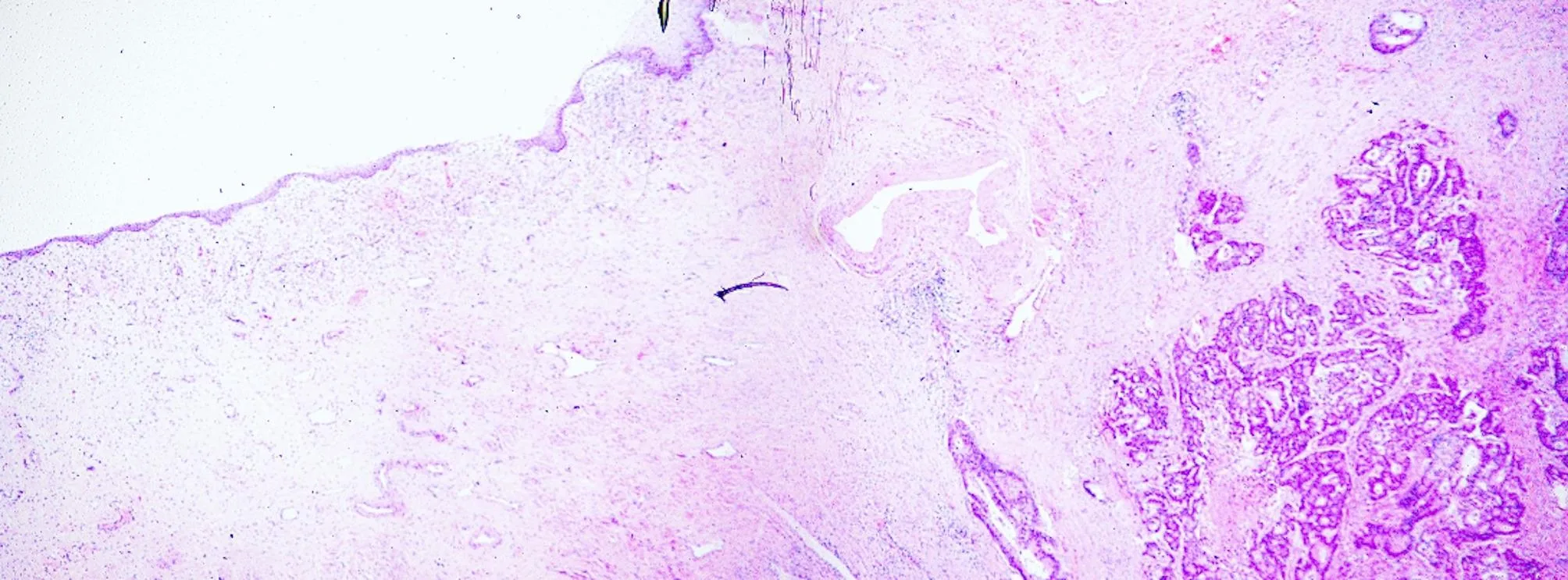 A patient, who was diagnosed with Stage IV Colorectal Adenocarcinoma