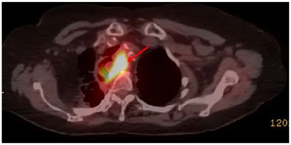 A patient, who was diagnosed with Stage IV Small Cell Lung Cancer