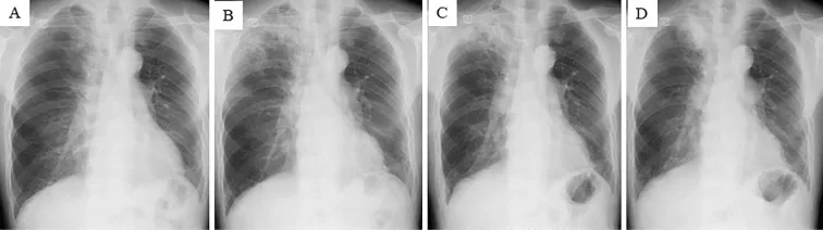 A patient, who was diagnosed with Lung Squamous Cell Carcinoma