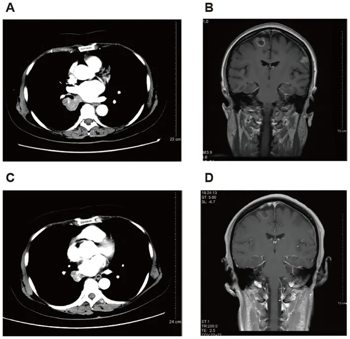 A patient, who was diagnosed with Stage IV Non-Small Cell Lung Cancer