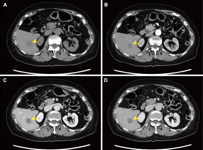 A patient, who was diagnosed with Stage I Lung Adenocarcinoma