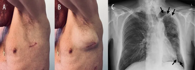 A patient, who was diagnosed with Lung Adenocarcinoma
