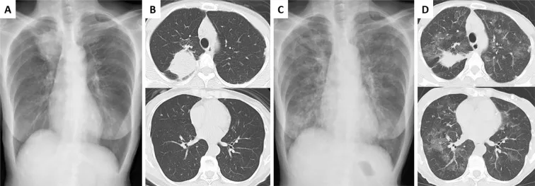A patient, who was diagnosed with Stage IV Lung Adenocarcinoma