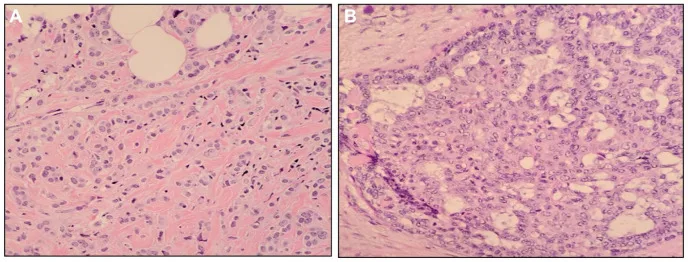 A patient, who was diagnosed with Invasive Lobular Carcinoma