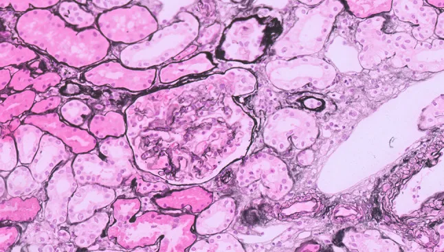 A patient, who was diagnosed with Stage IV Non-Small Cell Lung Cancer