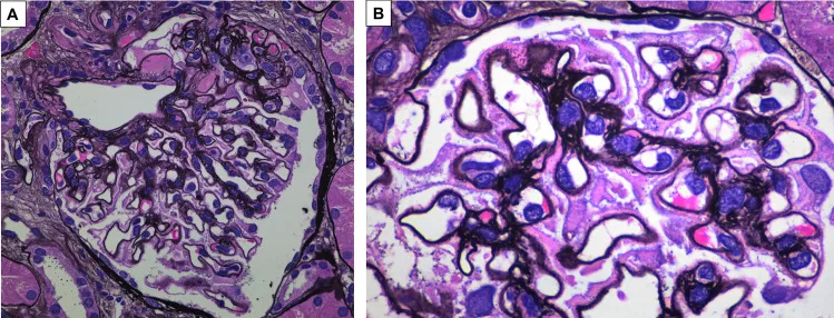 A patient, who was diagnosed with Gastric Adenocarcinoma