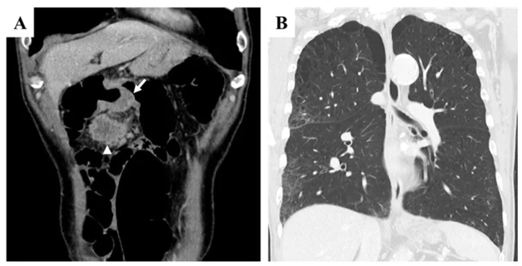 A patient, who was diagnosed with Stage IV Colorectal Adenocarcinoma