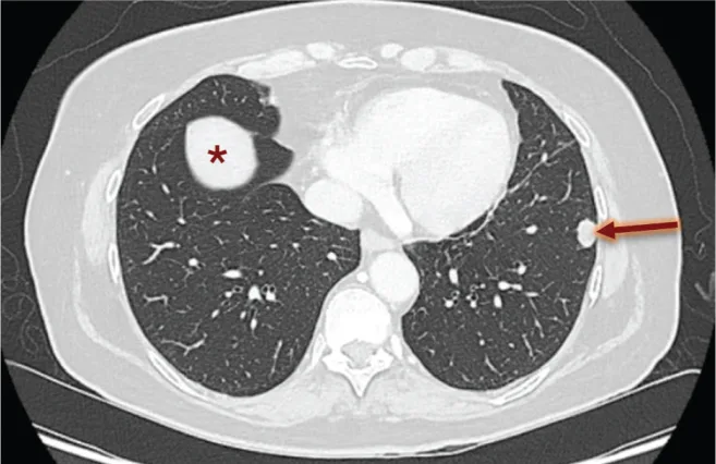 A patient, who was diagnosed with Stage IV Undifferentiated Pleomorphic Sarcoma