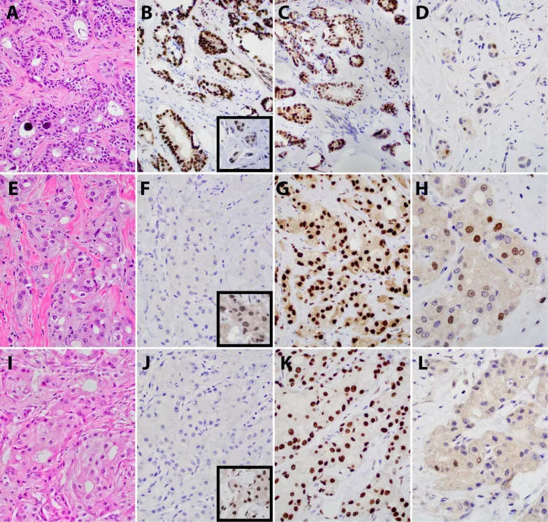 A patient, who was diagnosed with Invasive Ductal Carcinoma