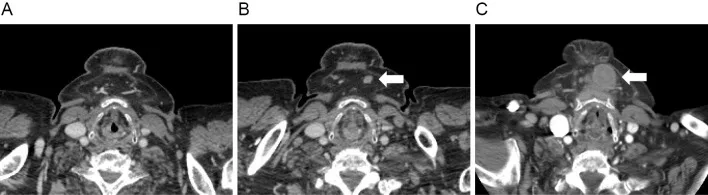 A patient, who was diagnosed with Stage III Lung Squamous Cell Carcinoma