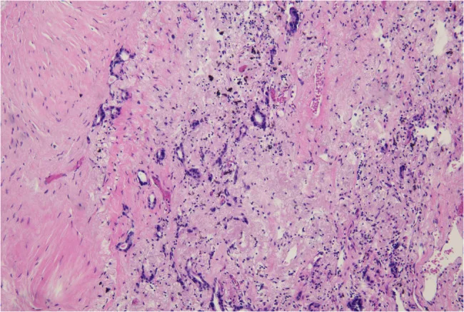 A patient, who was diagnosed with Stage IV Non-Small Cell Lung Cancer