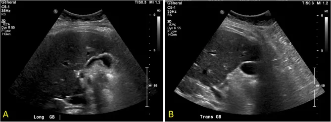 A patient, who was diagnosed with Stage IV Invasive Ductal Carcinoma