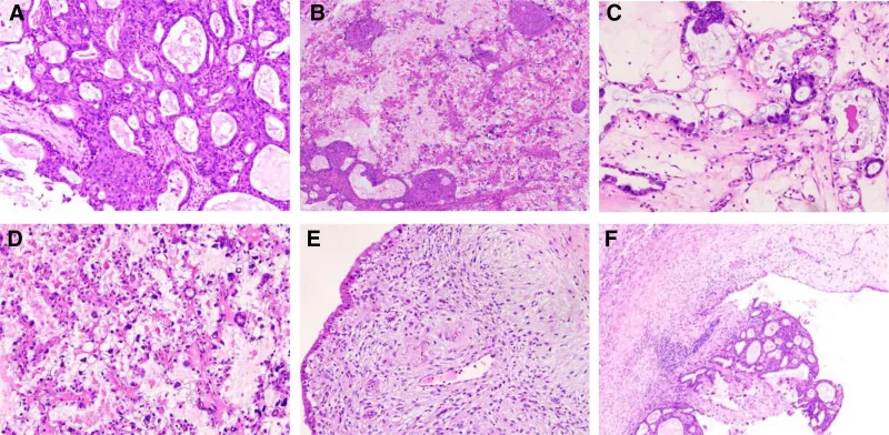 A patient, who was diagnosed with Ovarian Squamous Cell Carcinoma