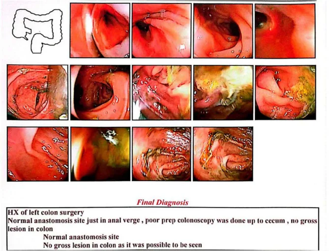 A patient, who was diagnosed with Stage I Colorectal Adenocarcinoma