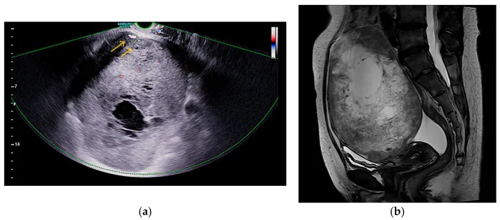 A patient, who was diagnosed with Ovarian Cancer