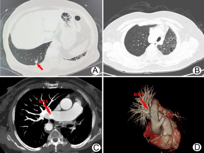 A patient, who was diagnosed with Lung Cancer