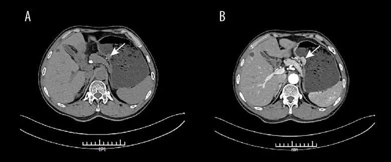 A patient, who was diagnosed with Gastric Adenocarcinoma