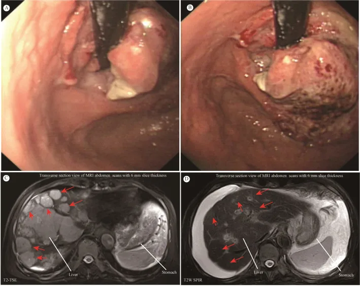 A patient, who was diagnosed with Stage IV Gastric Adenocarcinoma